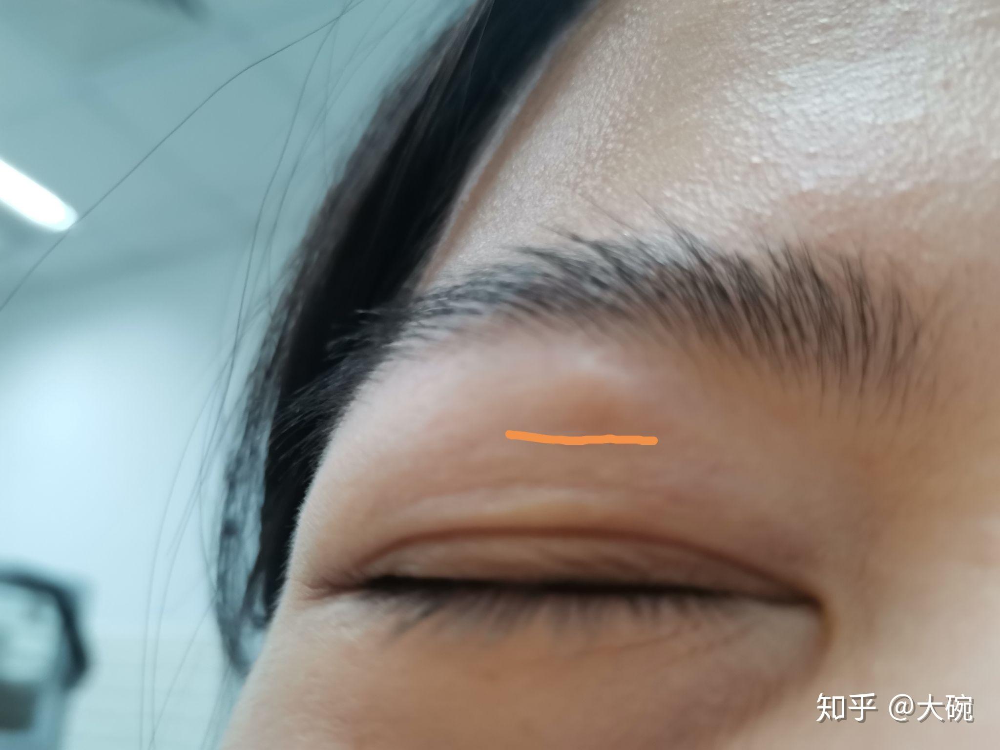 眉毛下皮肤里层长了一个疙瘩
