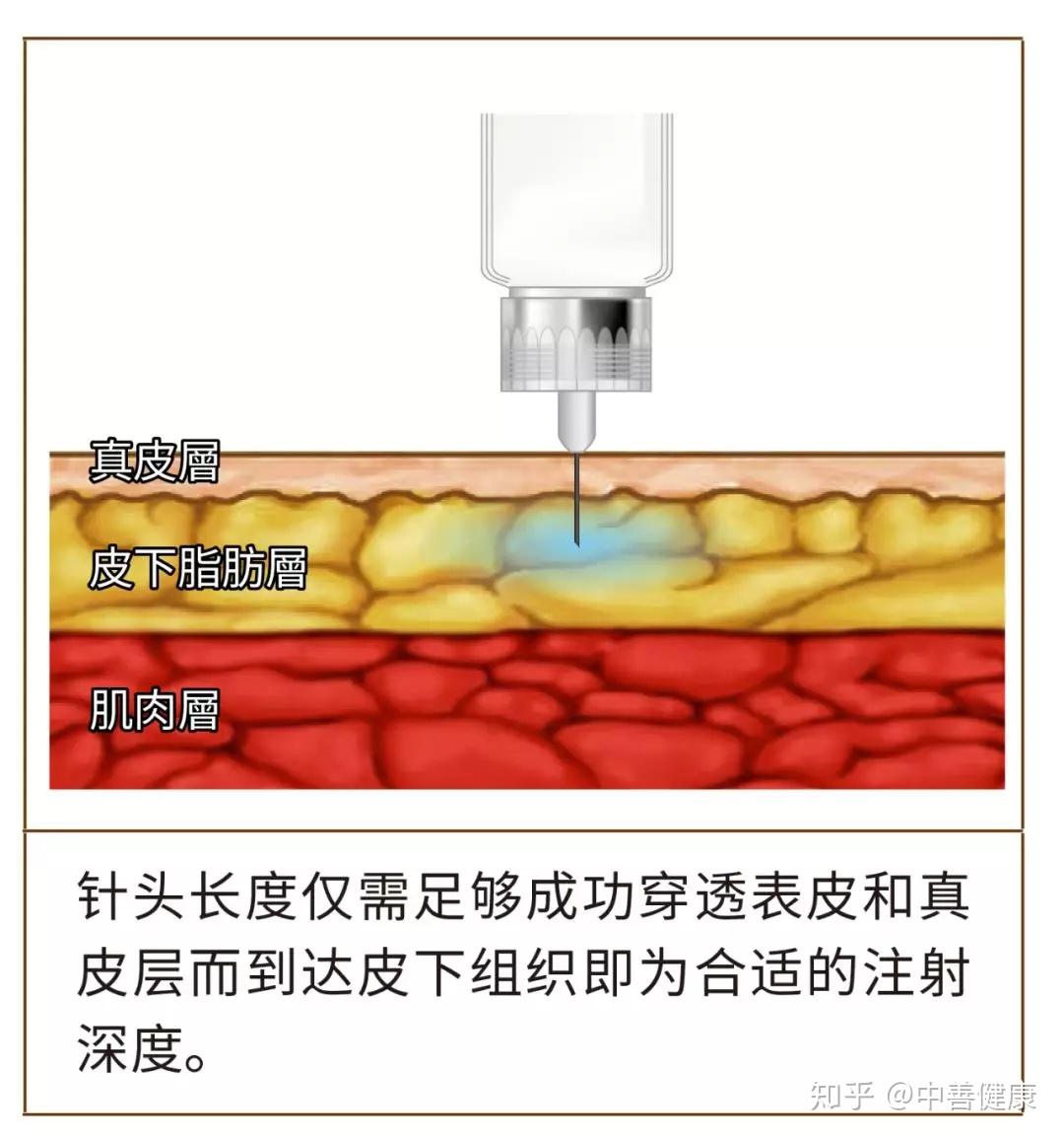 四大注射的角度图片