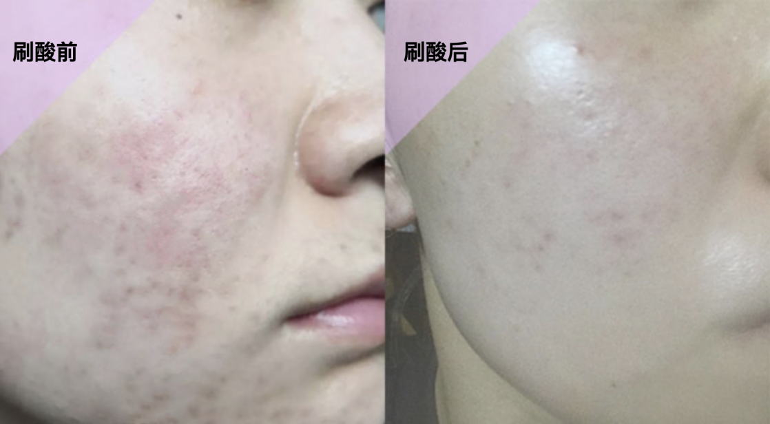 刷酸3个月我的痘肌变什么样了