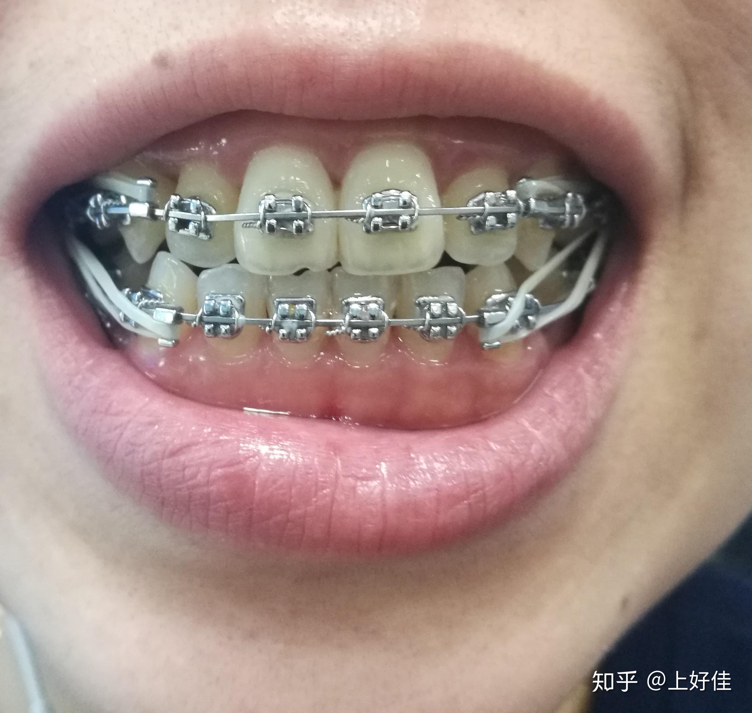 全同步带状弓整牙日记(每周一更,完更)20年6月-24年3月