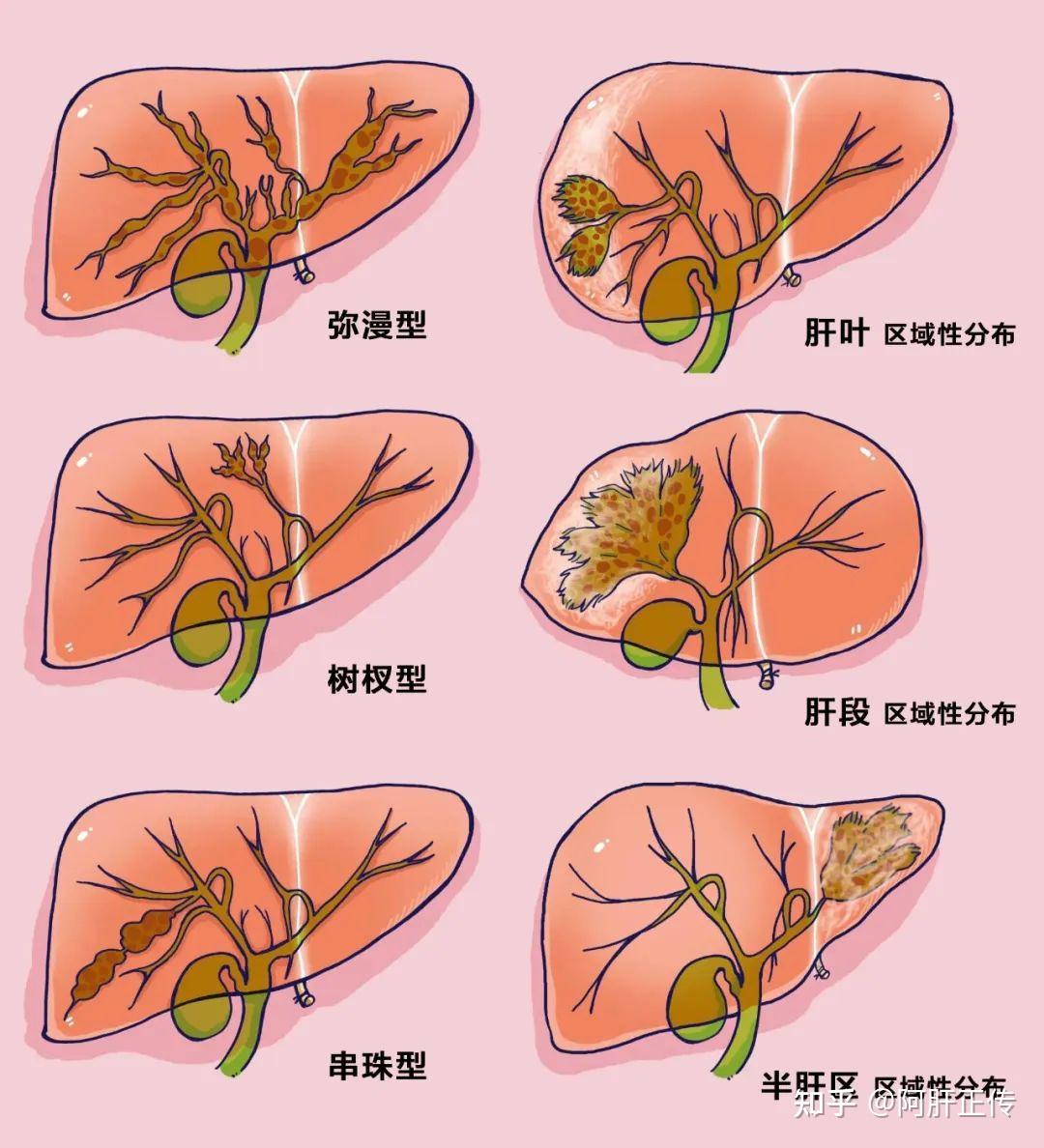 肝内胆管结石图片剖析图片