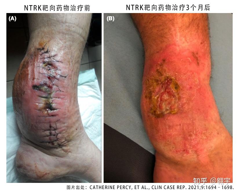 ntrk重排的软组织肉瘤因为这款神奇的靶向药避免了截肢