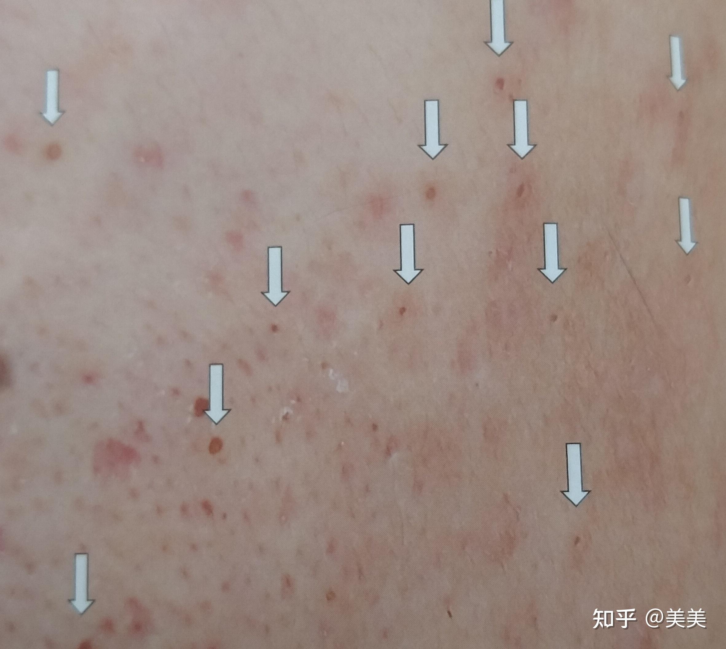 无论是哪种粉刺都是因为毛囊被角栓堵塞了.