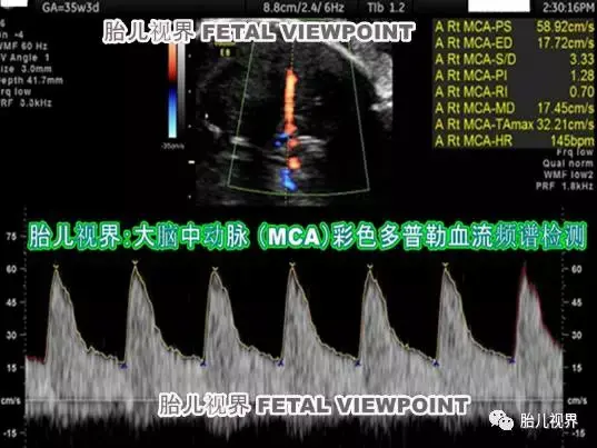 胎儿第四次超声：生长发育检测 (Interval Growth Ultrasound, IGU ) - 知乎