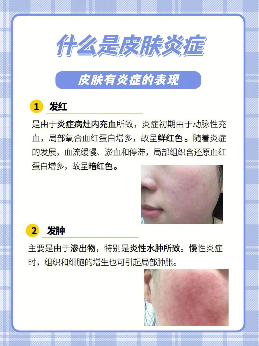 皮肤不好肯定有炎症！尤其反复长痘、过敏的 - 知乎