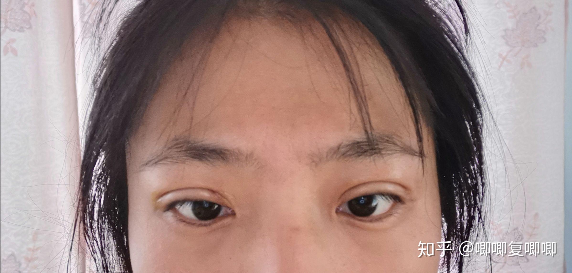 三点定位双眼皮记录