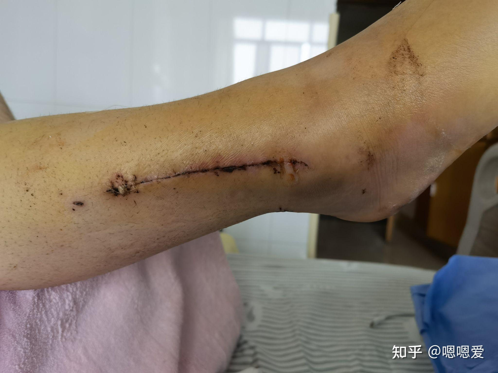 关于我骨折后的一些情况