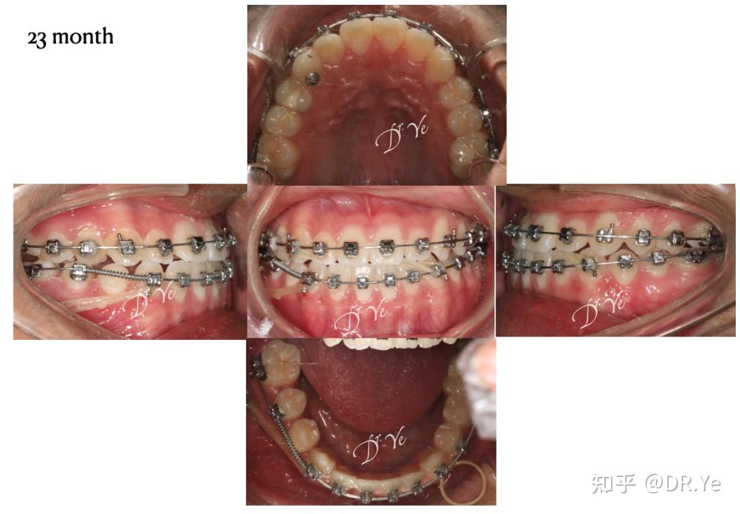 骨性地包天正畸代偿治疗