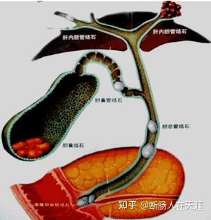 15. 胆系疾病 - 知乎