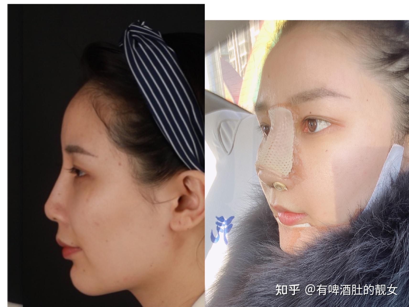北京最有名气隆鼻专家是谁？隆鼻医生预约排行榜 - 美妆技巧 - 整形医院排行榜
