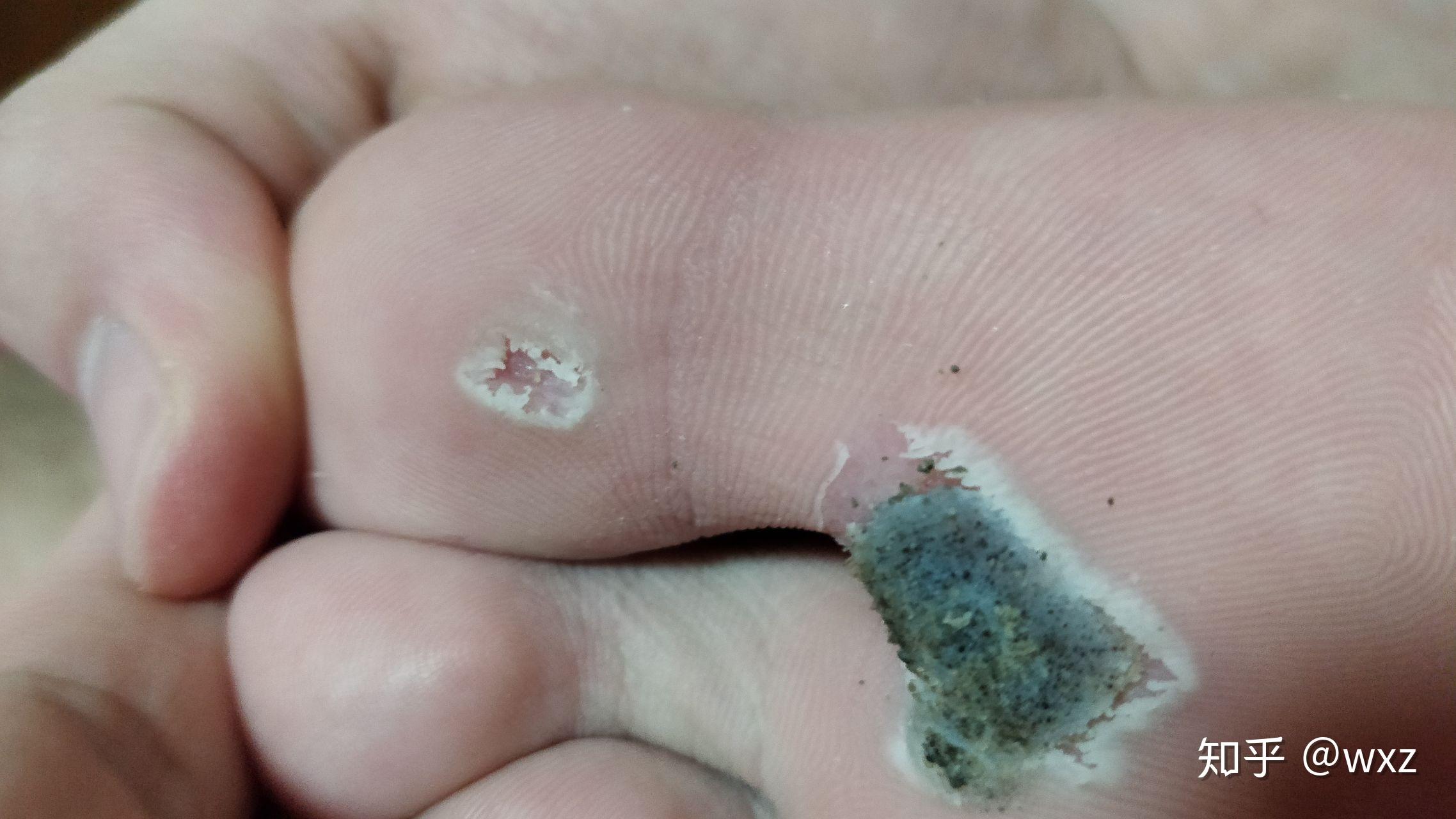 抗疣之路 - 知乎