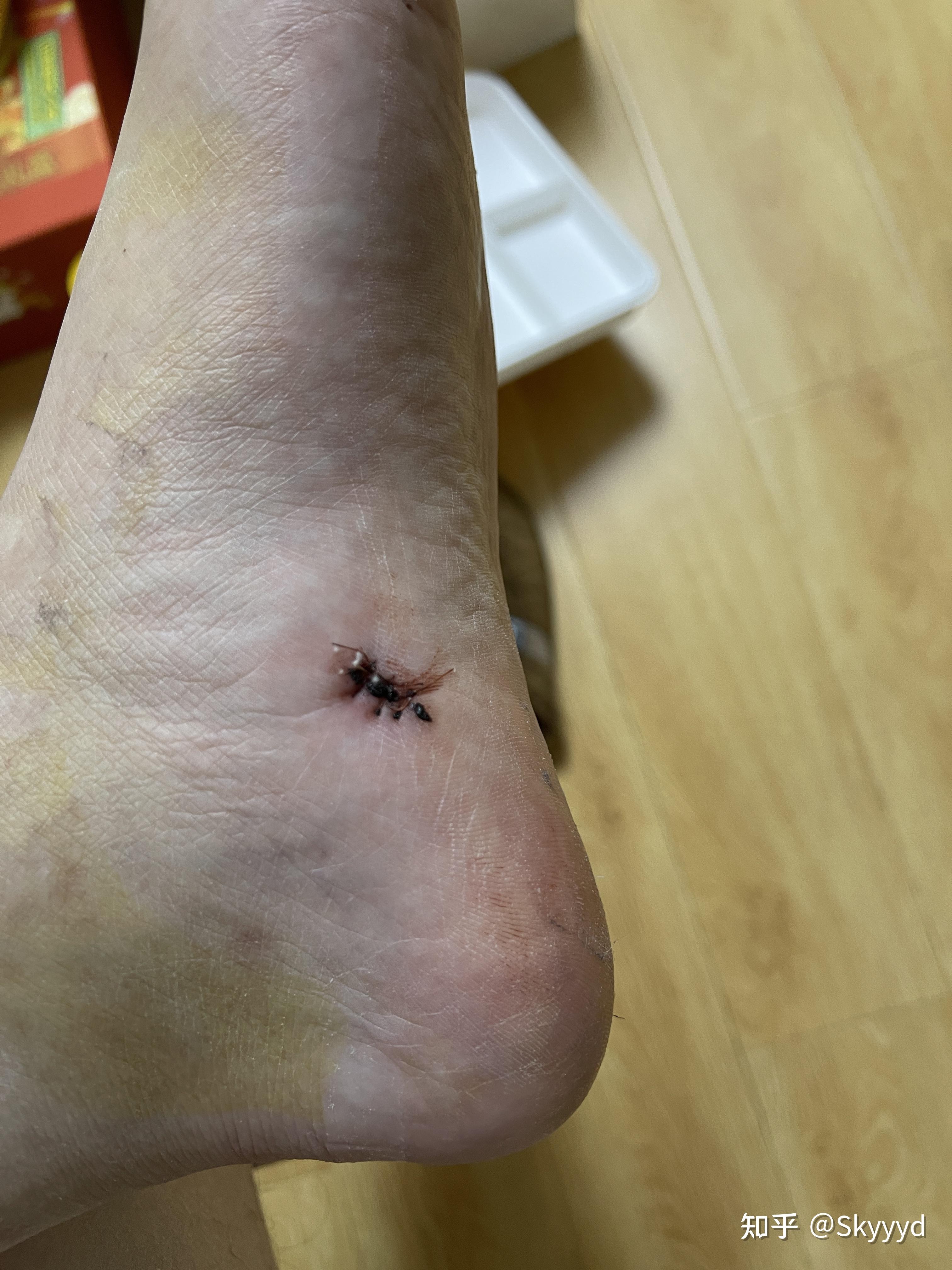 记录脚底色素痣切除全过程～ - 知乎