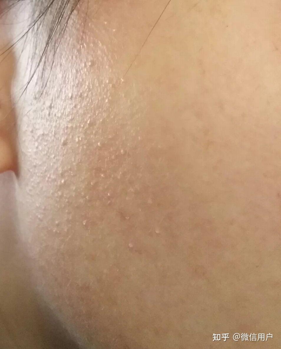 脸上一粒粒的是什么