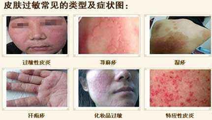 皮肤过敏的症状 知乎