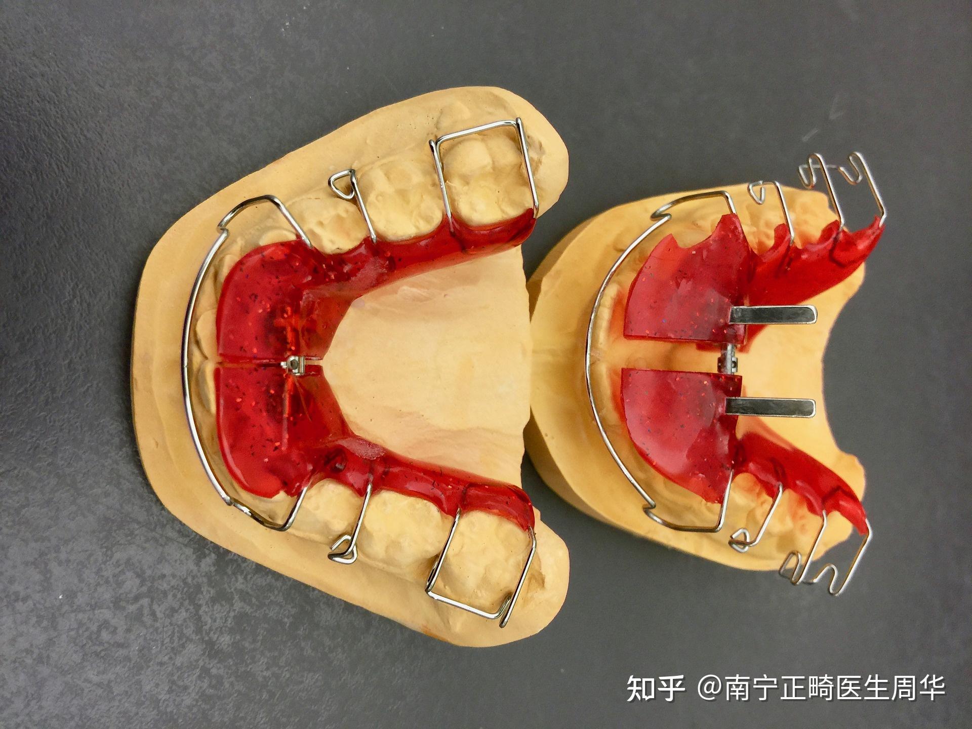 也就是通過科學的手段,矯正生長畸形的牙齒,藉助矯治器,讓原本排列不