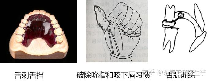 乳前牙反要重视早期矫正势在必行