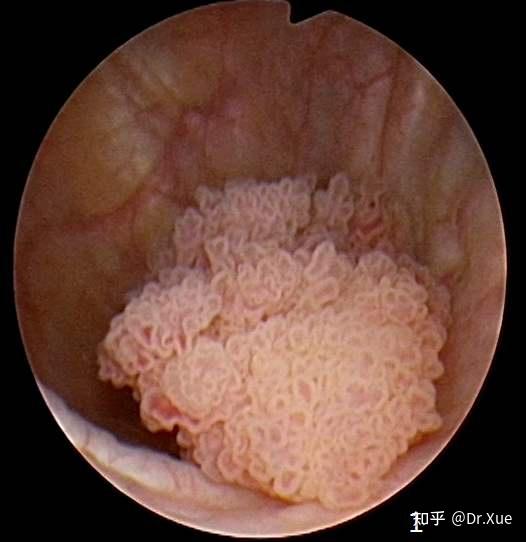 膀胱菜花状肿瘤图片图片