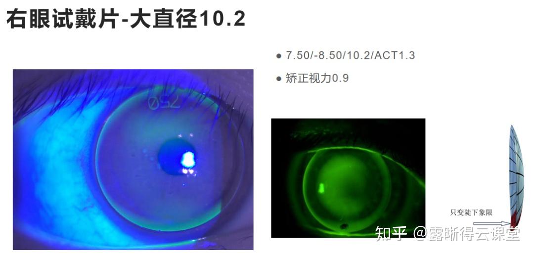 圆锥角膜的RGP验配及RGP临床效果分析（文字版） - 知乎