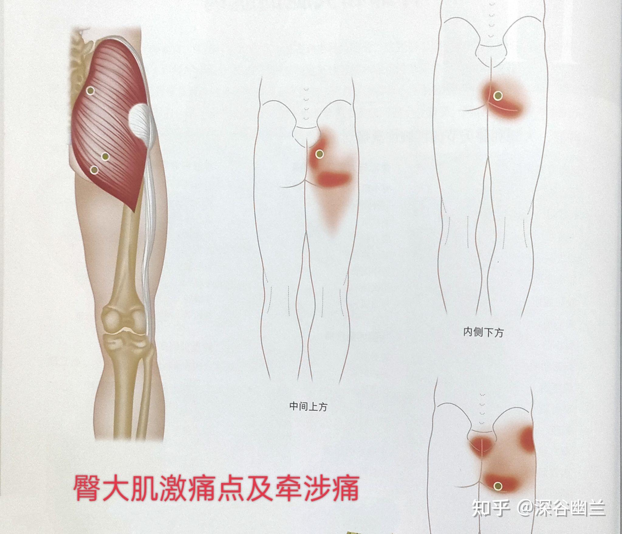 股直肌酸痛图片