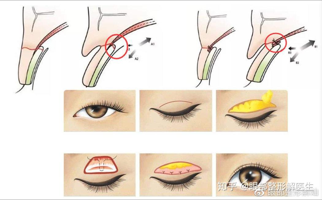 今天介绍一下重睑术的原理 - 知乎