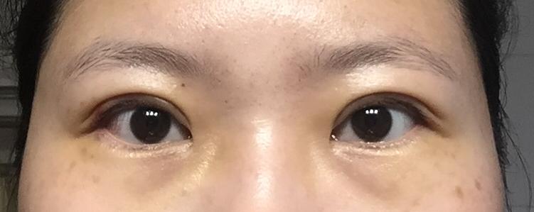 双眼皮手术后眼睛为什么刺痛? - 纸质飞机的回