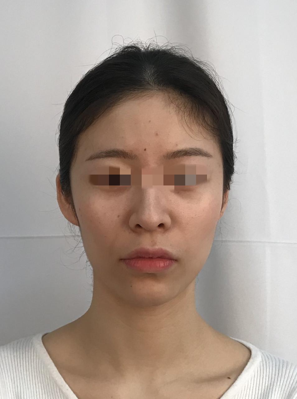 南宁面部填充有没有好的医生推荐南宁自体脂肪面部填充价格