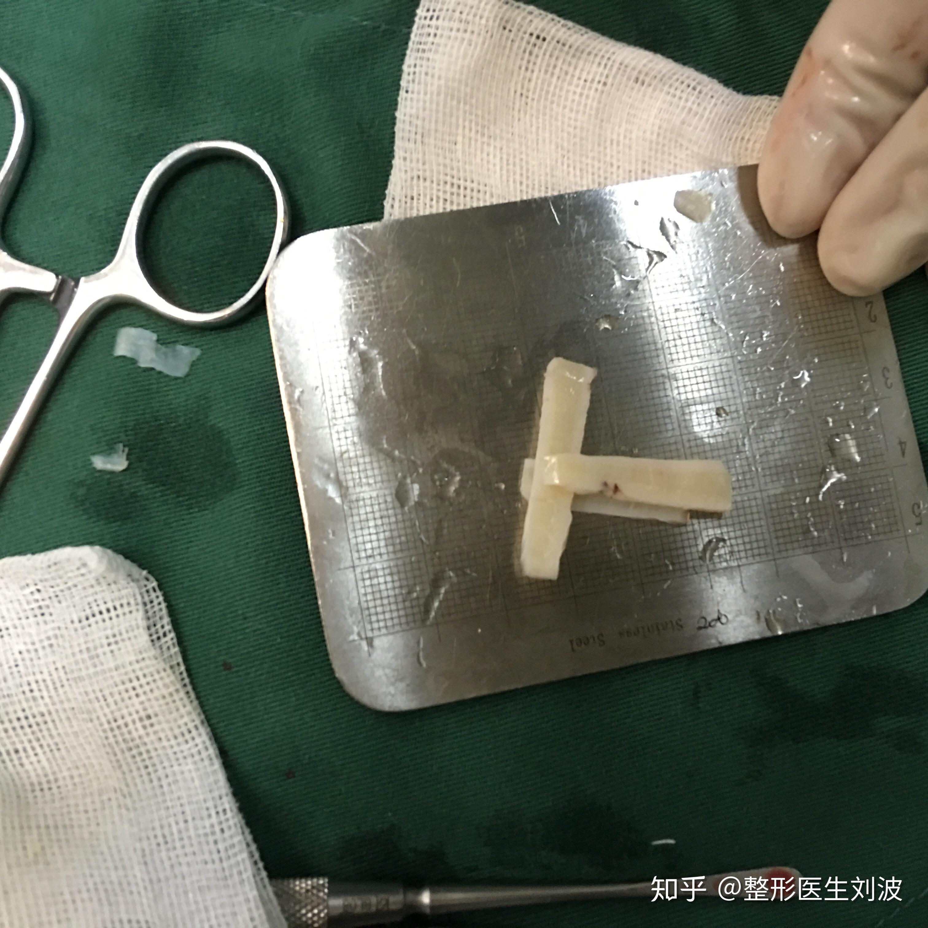 肋软骨隆鼻是怎么搭支架的