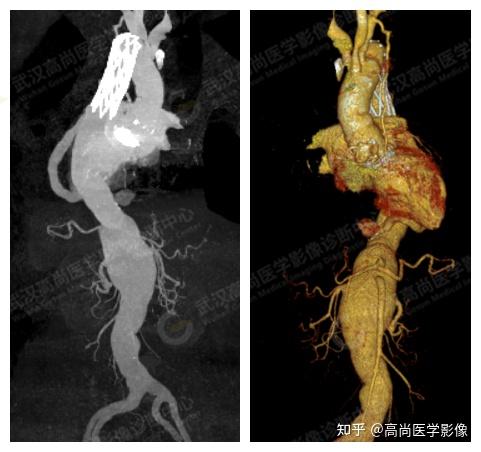 主动脉cta在马凡氏综合征人工血管置换术后的应用【高尚医学影像】
