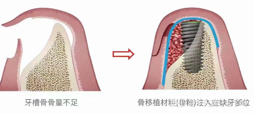 牙骨膜纤维图片