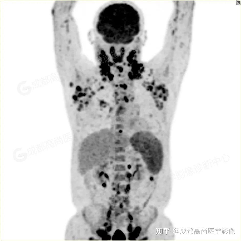 【高尚病例】全身多部位结核PET/CT显像一例 - 知乎