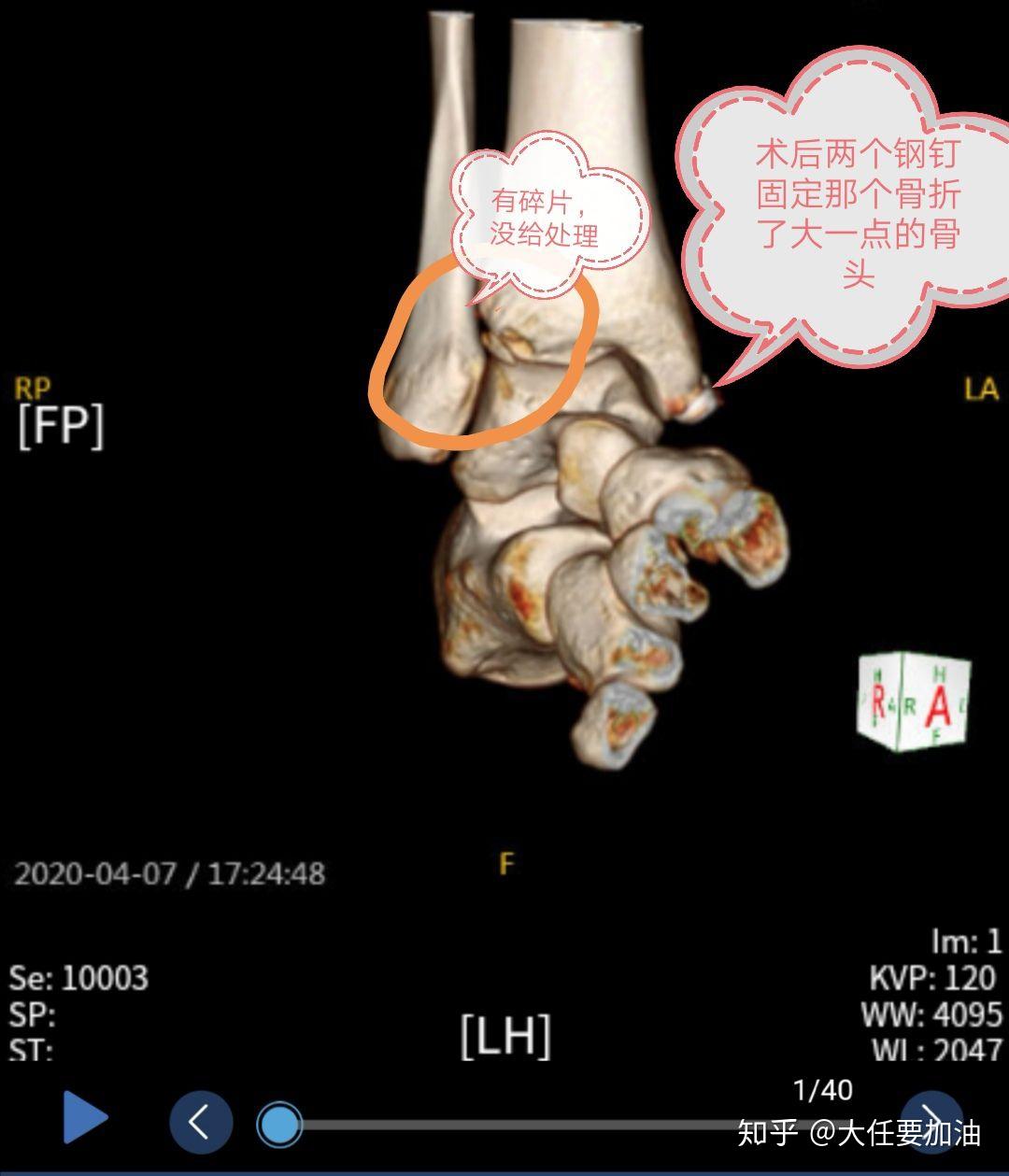 腳踝右側脛骨遠端骨折康復歷程