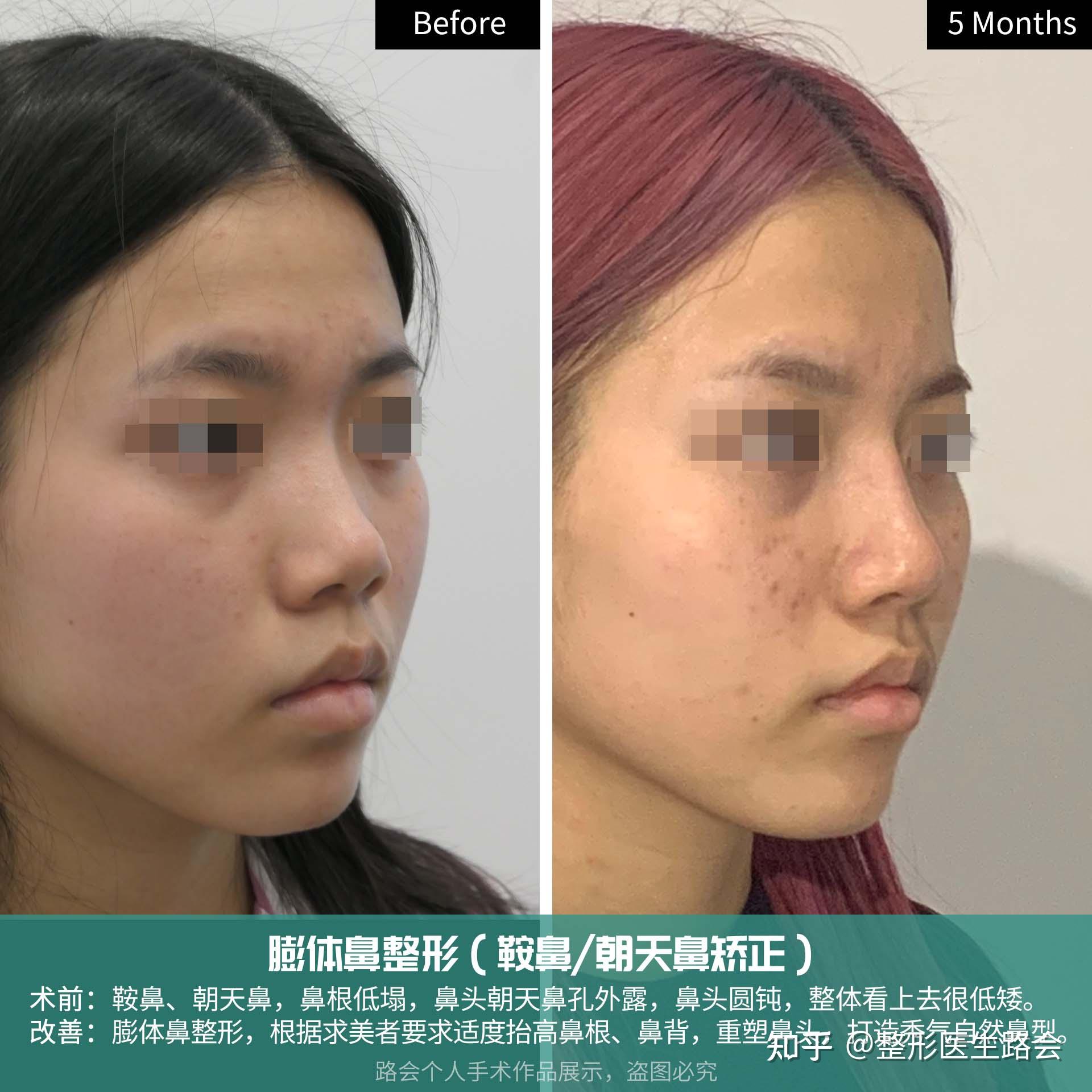 27岁“塌鼻子”女孩奔赴北京，做完鼻整形后5个月，真人案例告诉你这些“弯路”不要走！