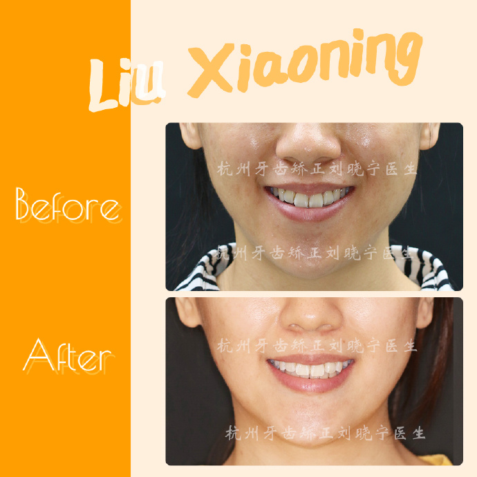 矫正牙齿医院排名_去医院矫正牙齿(2)