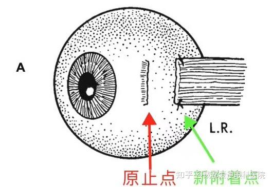 眼球斜視手術NGO水針刀 3D 美兆診所金門
