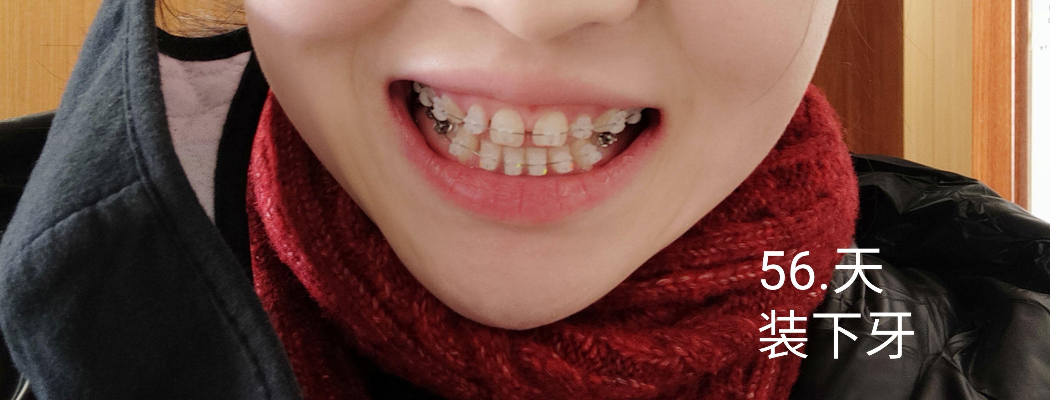 大龄正畸修复陶瓷自锁托槽牙缝和过小牙蜕变历程