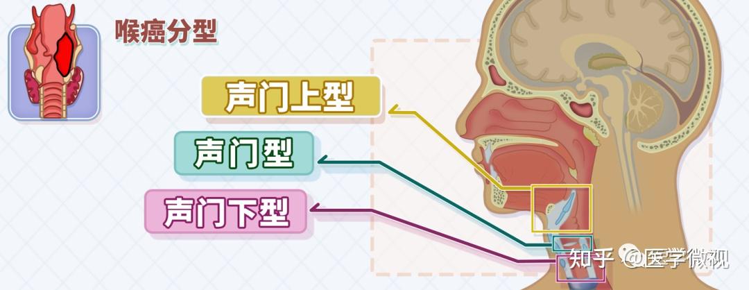 因为这种癌,他们学会了“食道语”这项傍身绝技! - 知乎