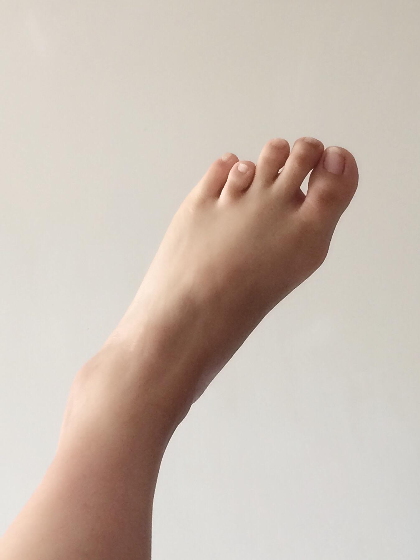 请问有人是第四脚趾短小症吗?