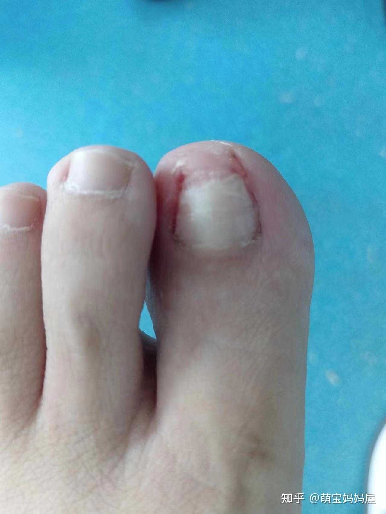 怀孕二胎期间得了嵌甲甲沟炎,我是这样解决的