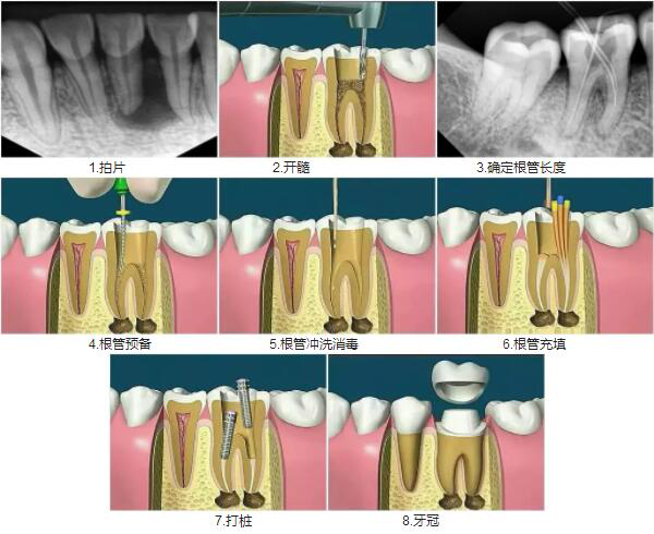 前牙根管治疗步骤图解图片