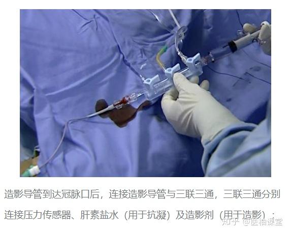 心脏支架的真实样子图解手术过程