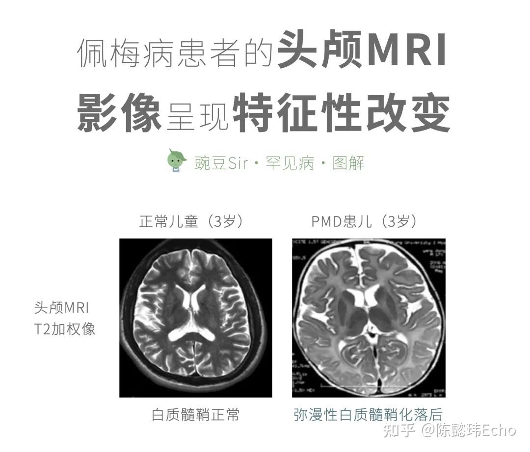 佩梅病图片