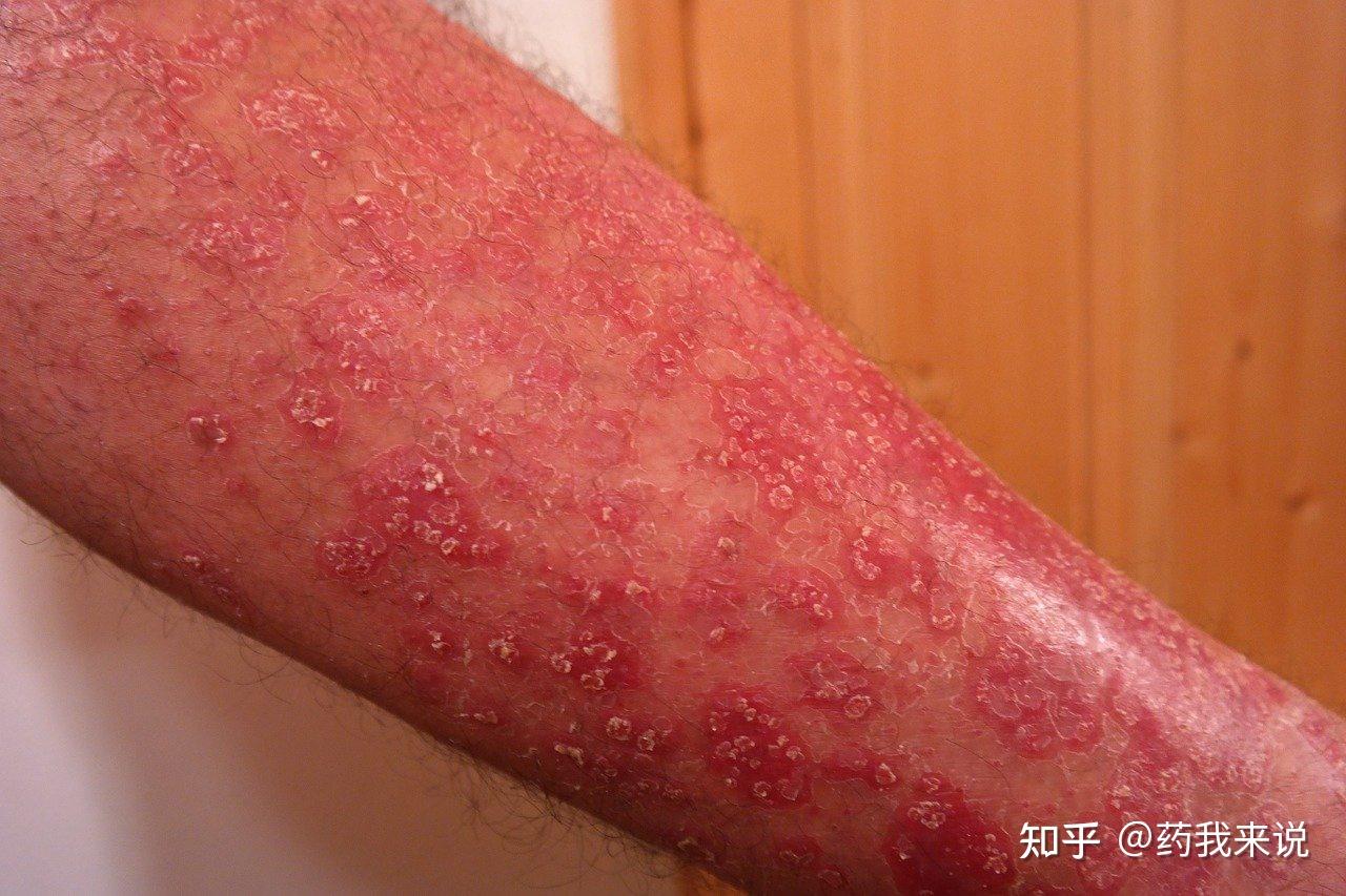 而阿奇霉素的不良反应主要包括过敏性休克,心律紊乱,血压下降,视觉与