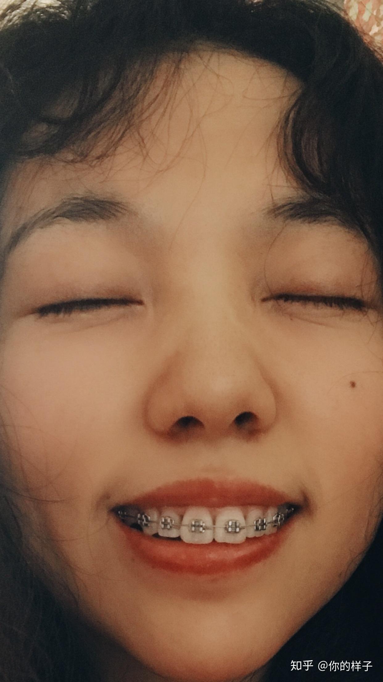 大龄女青年骨性嘴凸下巴后缩深覆合