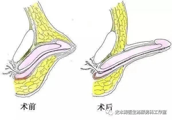 丁丁怎么变粗变大图片