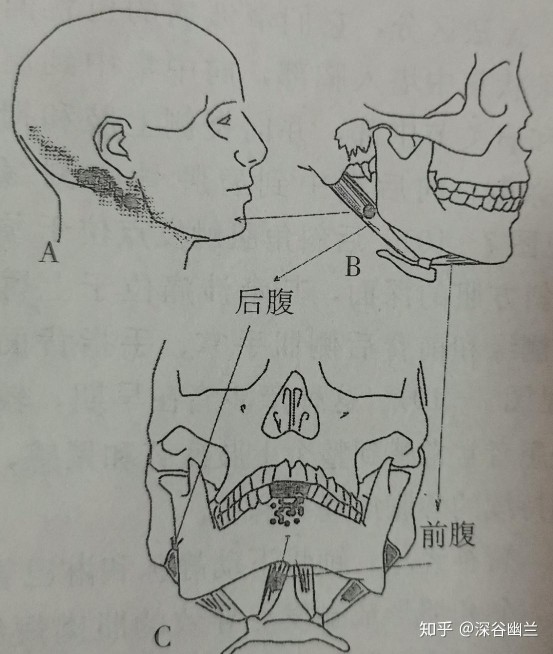 二腹肌和其他舌骨舌肌的觸發點,常常是繼發性的觸發