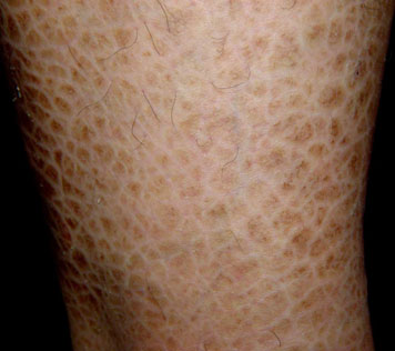 什么是鱼鳞病 为什么会得这种皮肤病 知乎