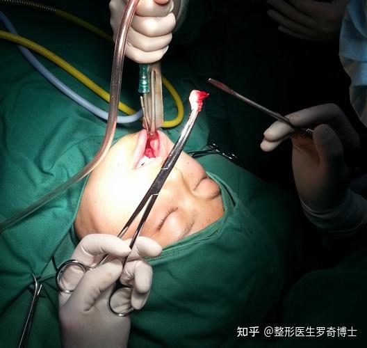 局部麻醉下磨骨瘦脸下颌角削骨手术过程