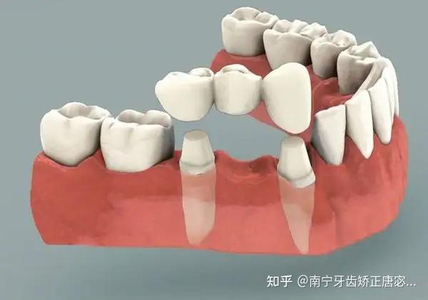 若選擇隱形矯正,就沒有這個問題.具體選擇什麼方案進行矯