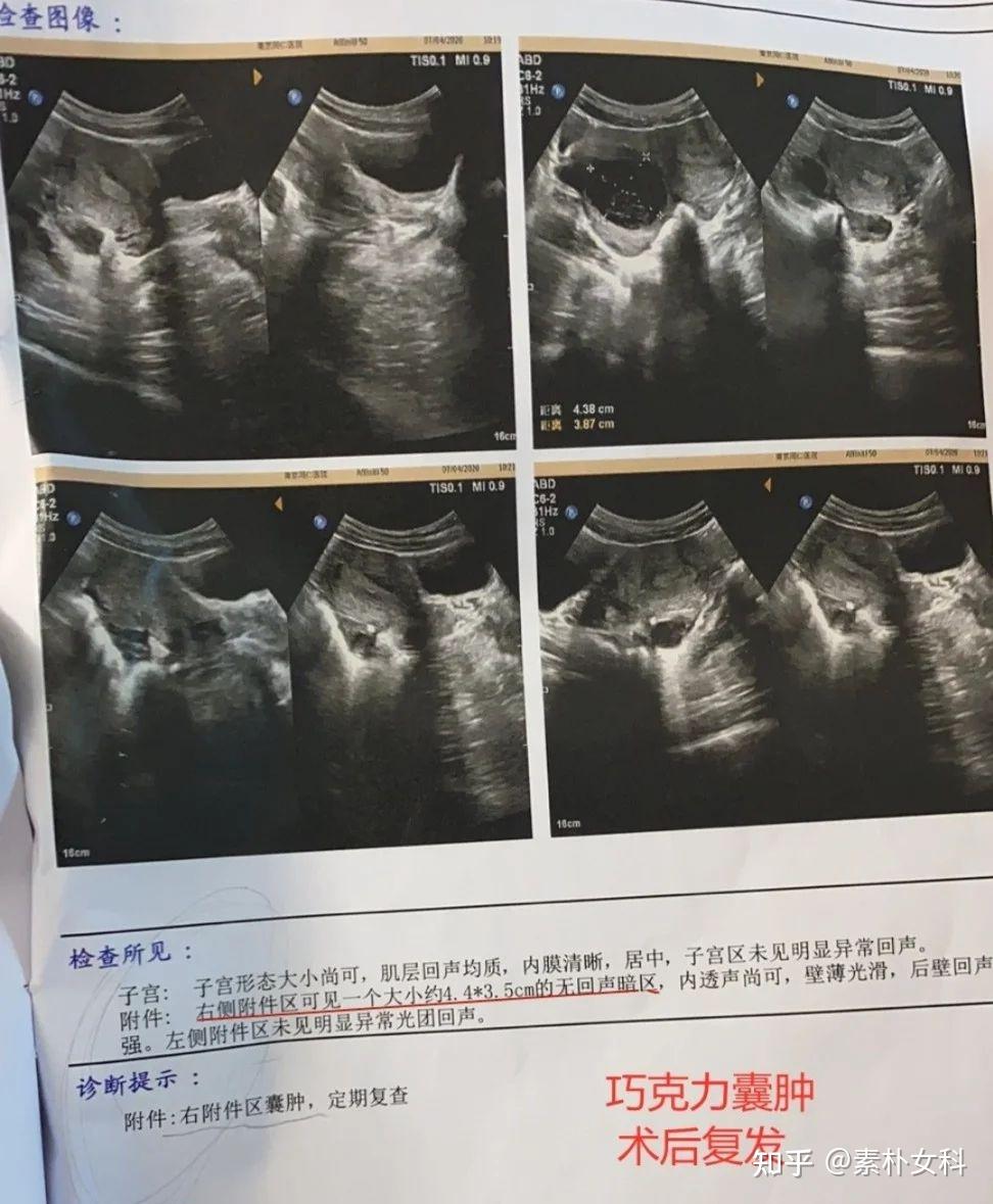 巧克力囊腫術後復發4公分中醫調理2個月效果令人意外