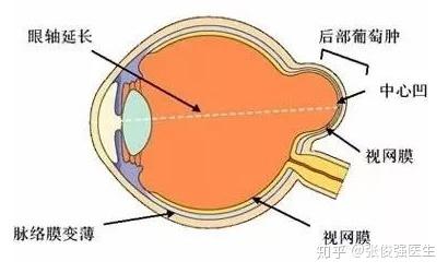 后巩膜葡萄肿能治好吗 后巩膜葡萄肿前兆 茶文网